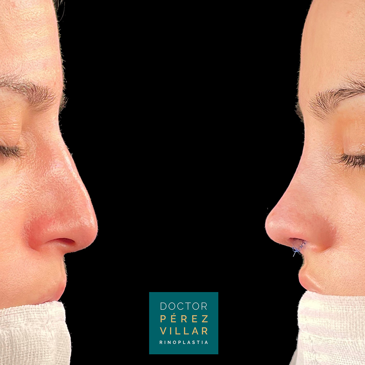 Before and after image showing the side profile of a woman after rhinoplasty, with visible stitches and an improved nose shape, presented by Dr. Pérez Villar.