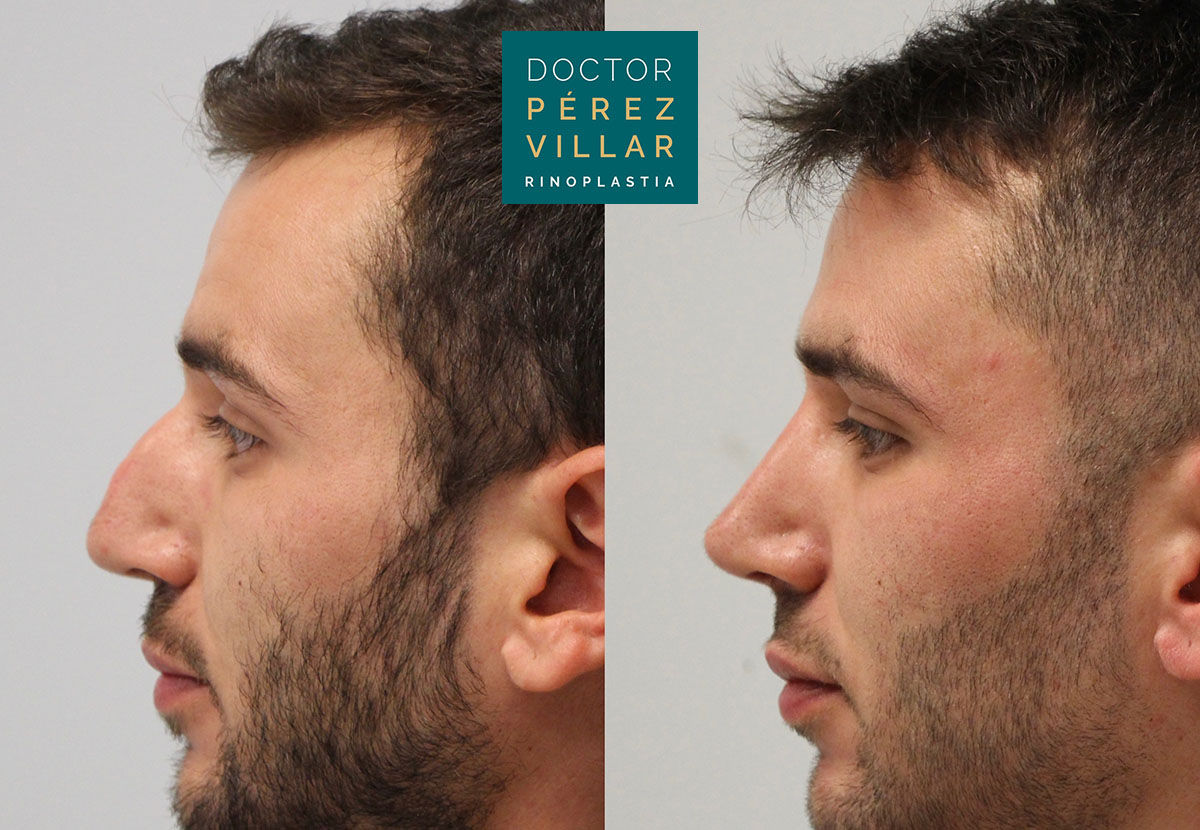 Before and after image showing the side profile of a man who underwent rhinoplasty, emphasizing the improved nose shape, presented by Dr. Pérez Villar.