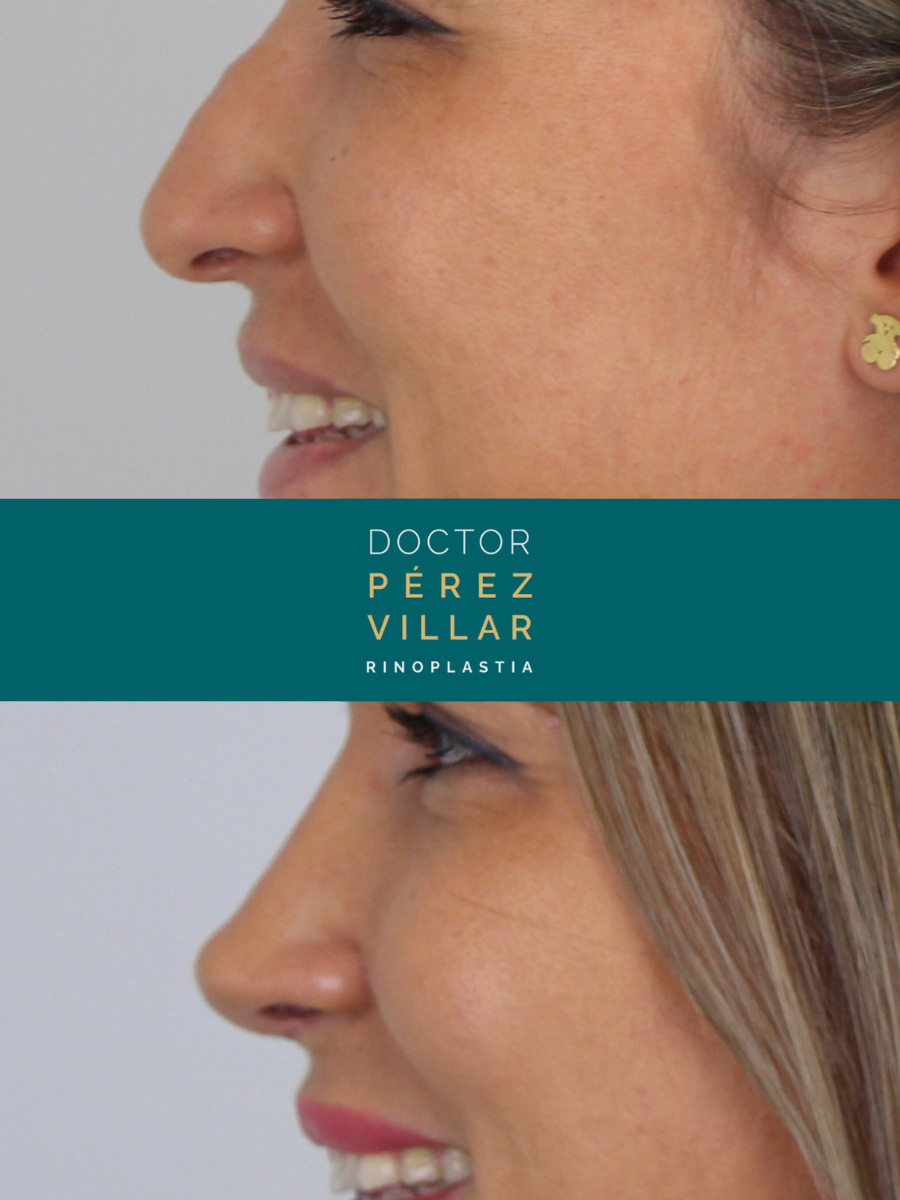 Before and after image showing the side profile of a woman who underwent rhinoplasty, emphasizing the improved nose shape, presented by Dr. Pérez Villar.