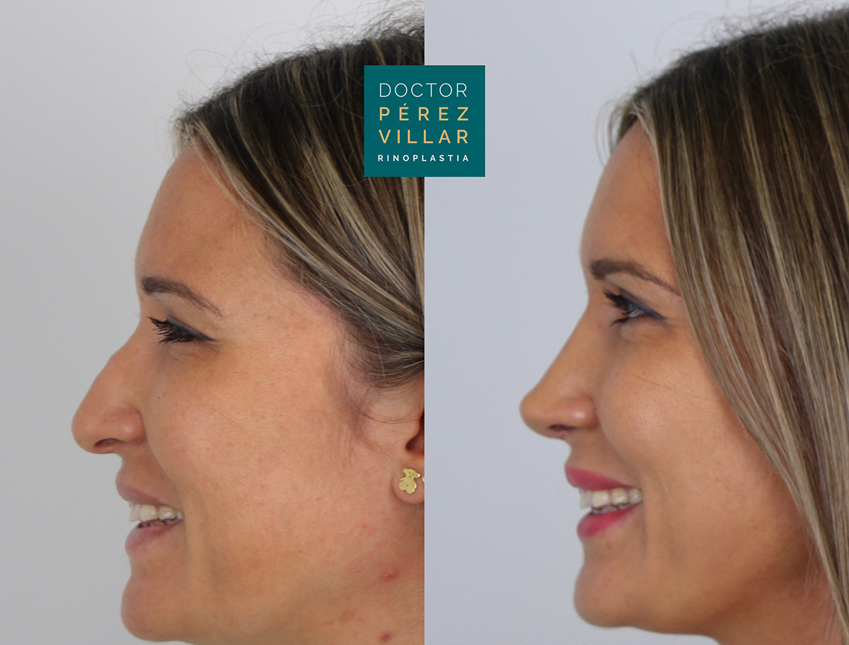 Before and after image showing the side profile of a woman who underwent rhinoplasty, highlighting the improved nose shape, offered by Dr. Pérez Villar.
